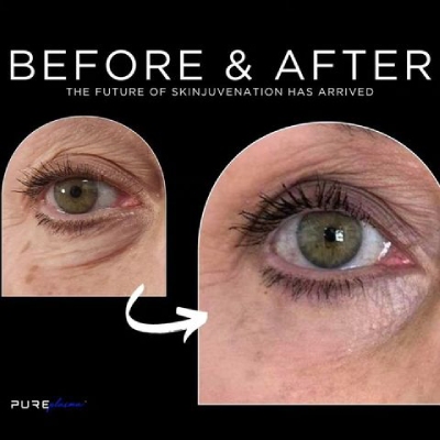 Pure Plasma Skin Rejuvenation instagram photo