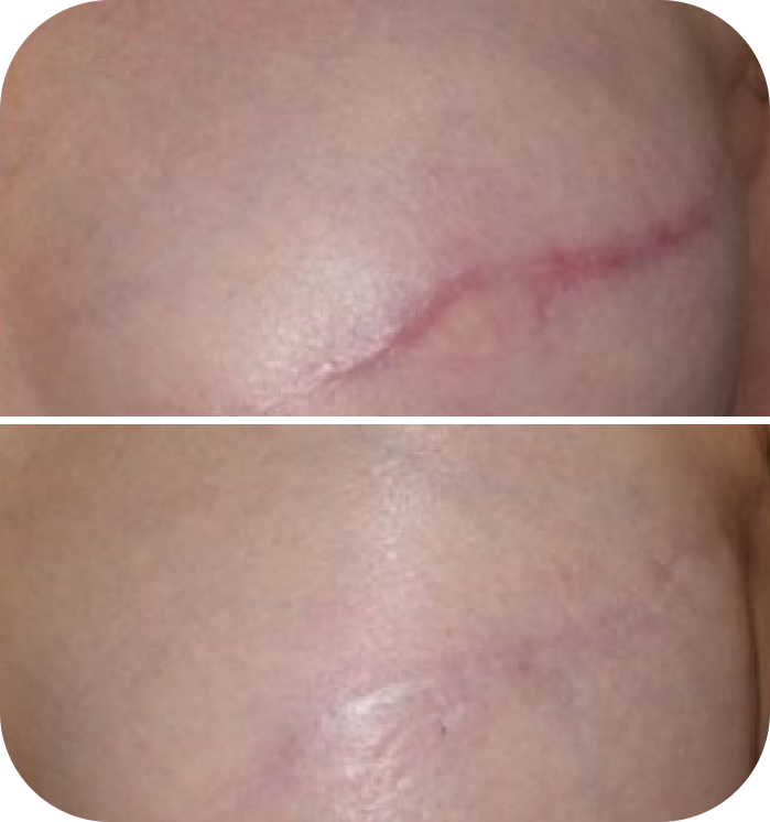 Pure Plasma Before and After