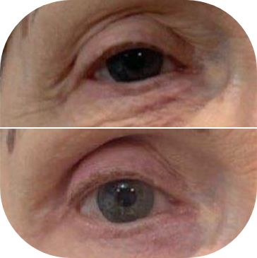 Pure Plasma Before and After Blepharoplasty