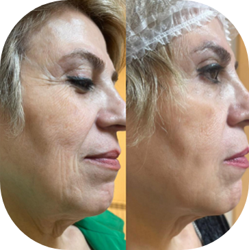 Pure Plasma Before and After Bioidentical Hormone Therapy