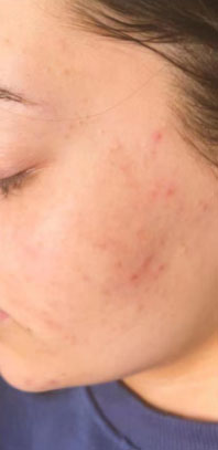 Acne Before & After Patient #84