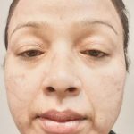 Skin Tightening Before & After Patient #105