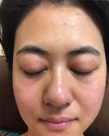 Skin Tightening Before & After Patient #112