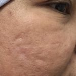 Skin Tightening Before & After Patient #115