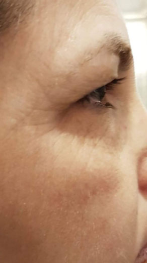 Skin Texture Resurfacing Before & After Patient #131