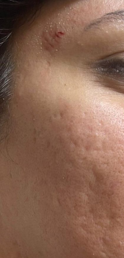 Skin Texture Resurfacing Before & After Patient #168
