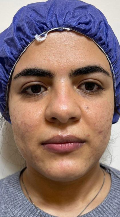 Acne Scars Before & After Patient #171