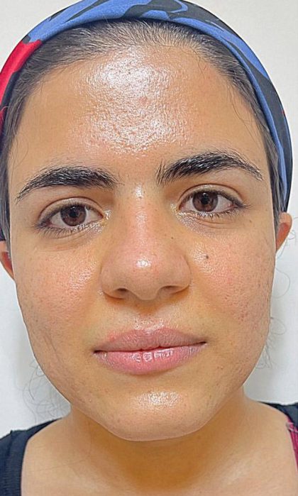 Acne Scars Before & After Patient #171