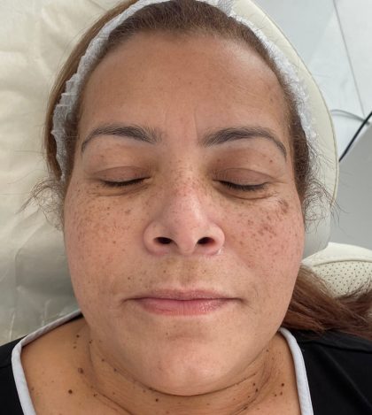 Skin Tightening Before & After Patient #193