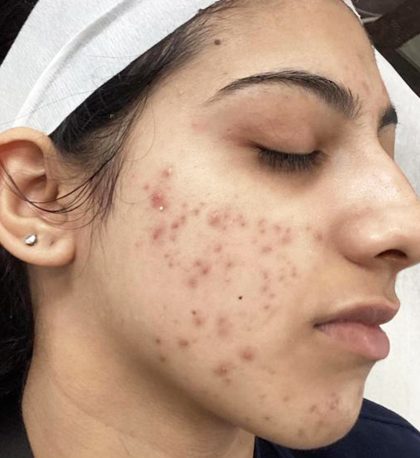 Severe Acne Before & After Patient #407