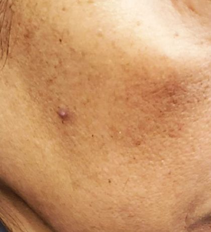 Skin Texture Resurfacing Before & After Patient #413