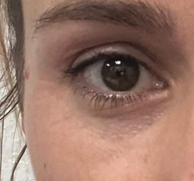 Crepey Eyelids Before & After Patient #533