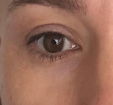 Crepey Eyelids Before & After Patient #533