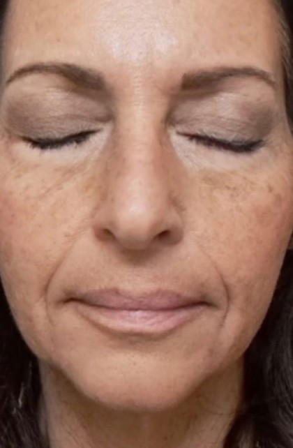 Skin Texture Resurfacing Before & After Patient #617