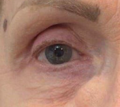 Eyelid Tightness Before & After Patient #573
