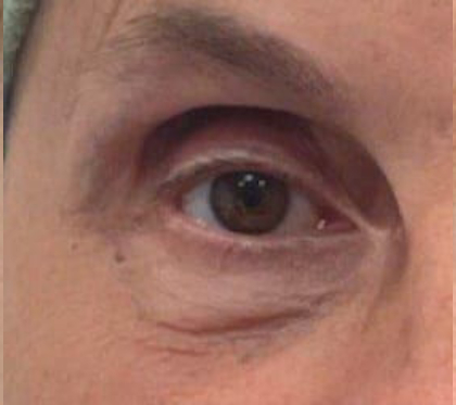 Eyelid Tightness Before & After Patient #582