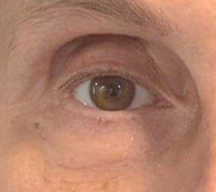 Eyelid Tightness Before & After Patient #582