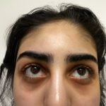 Eyelid Tightness Before & After Patient #584