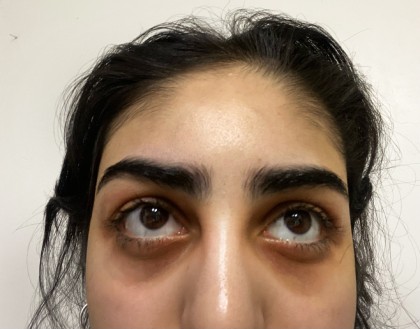 Eyelid Tightness Before & After Patient #584
