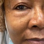 Eyelid Tightness Before & After Patient #587