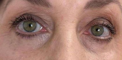 Eyelid Tightness Before & After Patient #687