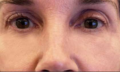 Eyelid Tightness Before & After Patient #689