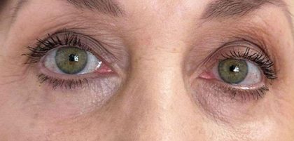 Eyelid Tightness Before & After Patient #691